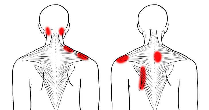 Understanding Neck Spasms: How to Find Relief