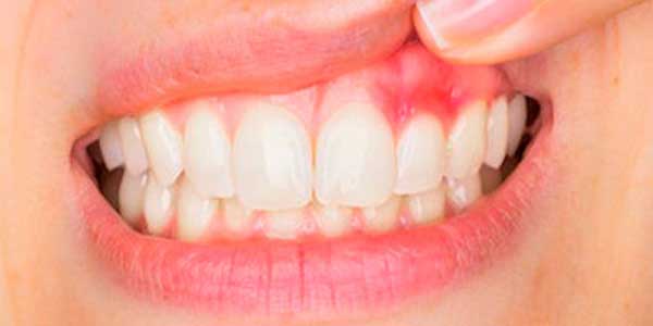 Some Home Remedies for Gingivitis