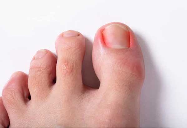 Happy Feet: 5 Tips to Remedy Ingrown Toenails