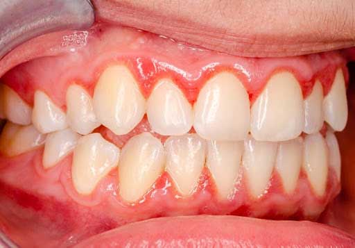 Some Home Remedies for Gingivitis