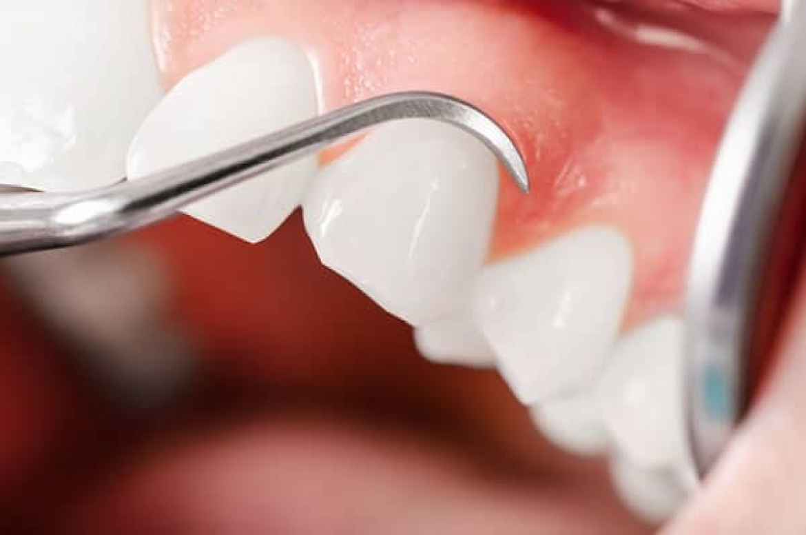 آیا مواد باندینگ دندان, سرطان زا هستند؟