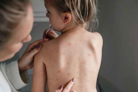 ۷ Home Remedies for Chickenpox