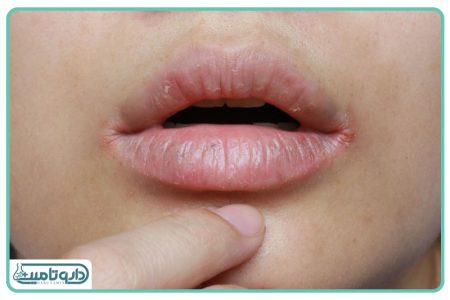 Lip Cancer