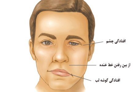 How Serious a Condition is Bell’s Palsy