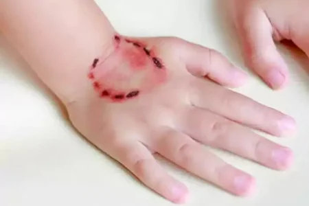 افزایش ۱۰ درصدی حیوان گزیدگی در اصفهان