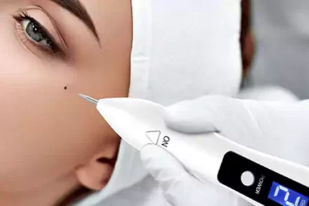 خال‌ها؛ خوش‌خیم یا خطرناک؟