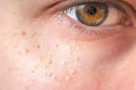 درمان خانگی میلیا زیر چشم + ۴ راهکار خانگی برای رفع سریع کیست‌های سفید