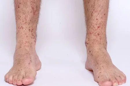 همه چیز درباره بیماری شامبرگ